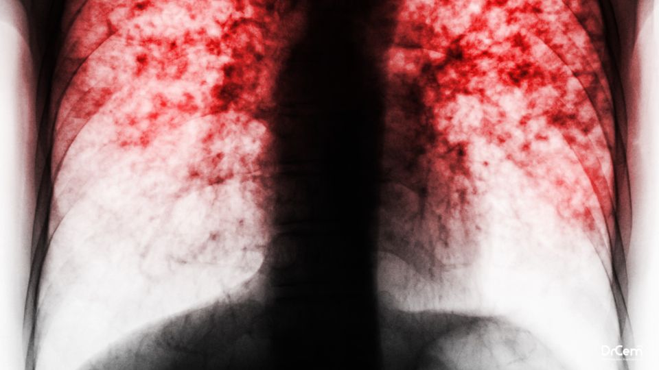 Pulmoner Fibröz görseli - DrCem hastalık rehberi